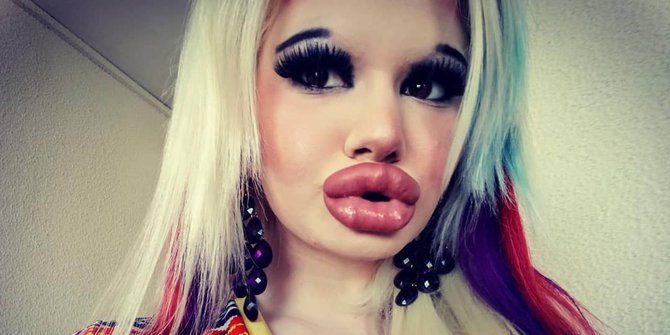 Mahasiswi Bulgaria Oplas 15 Kali Demi Bibir Terbesar di Dunia
